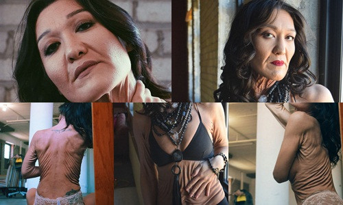 Người mẫu 26 tuổi có làn da nhăn nhún như bà già 80 tuổi là Sara Geurts ở Los Angeles.