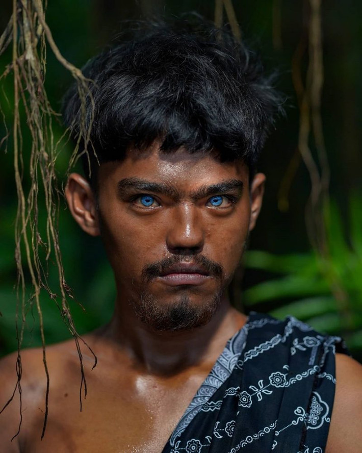 Những người mắc hội chứng Waardenburg thường sở hữu đôi mắt xanh nhạt hoặc có hai màu khác nhau ví dụ như một mắt màu nâu và mắt còn lại màu xanh.