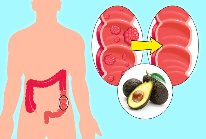 8. Ngăn ngừa ung thư: Quả bơ có khả năng tiêu diệt các tế bào gây ung thư và ngăn ngừa bệnh này phát triển.