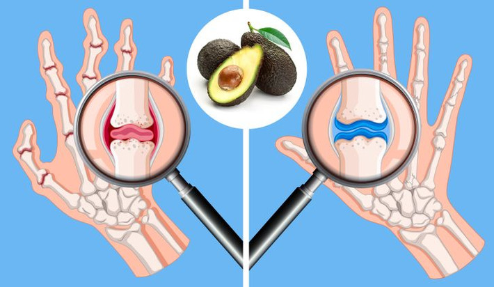 10. Giúp làm giảm các triệu chứng của bệnh viêm khớp: Những người bị viêm khớp thường phải đối mặt với những cơn đau khớp, nhưng ăn bơ có thể giúp họ giảm đau. Trái cây có đặc tính chống oxy hóa và giảm đau hiệu quả.
