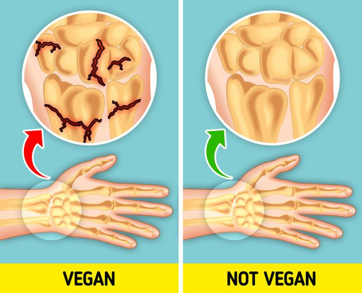 10. Xương dễ gãy hơn: Chế độ ăn thuần chay khiến bạn nhận mức canxi và vitamin D thấp hơn so với những người không ăn chay. Điều này có thể khiến bạn có nguy cơ loãng xương cao hơn, khi mật độ xương của bạn thấp hơn và chúng có thể dễ gãy hơn, theo một nghiên cứu mới được thực hiện bởi Oxford. Điều này một phần là do những người ăn chay trường có chỉ số BMI thấp hơn, vì họ có nhiều khả năng bị gãy xương hông, chân và đốt sống. Ảnh: BS.