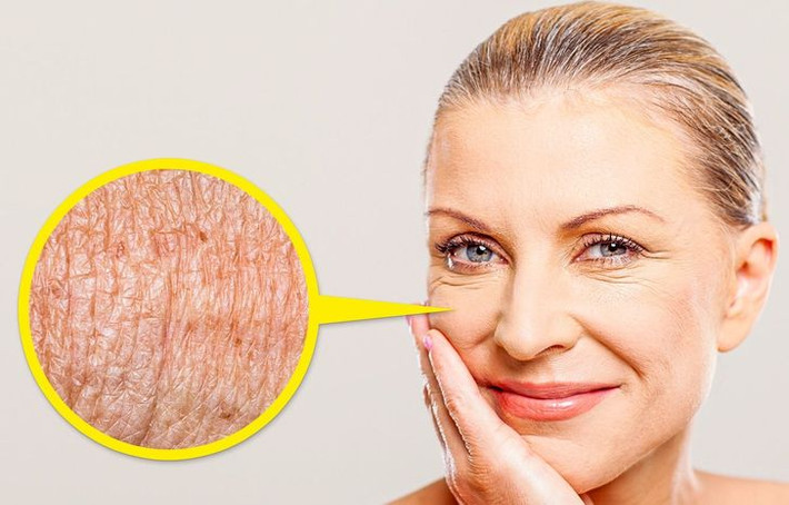 4. Da nhăn nheo: Tiếp xúc lâu với ánh nắng mặt trời mà không dùng kem chống nắng là lý do chính gây ra điều này. Những tổn thương này là do sự phân hủy elastin khiến da không thể căng lại như bình thường và làm da nhăn nheo.