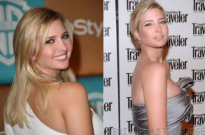 Chiếc mũi của Ivanka rõ ràng cao, thẳng hơn so với lúc cô còn trẻ rất nhiều và nhờ thế mà vẻ mặt của cựu người mẫu cũng thanh thoát hơn.