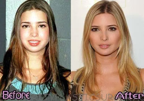 Khuôn mặt của Ivanka Trump thay đổi rất nhiều khi so hai bức ảnh niên thiếu và trưởng thành. (Ảnh: thecelebrityplasticsurgery)