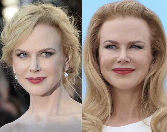 Năm 2014, xuất hiện tại Liên hoan Phim Cannes để quảng bá phim Grace of Monaco, mọi người đều ngã ngửa khi nhìn thấy khuôn mặt cứng đờ vì Botox của Nicole Kidman (trái). Trước đó một năm, ngôi sao Hollywood thừa nhận cô tiêm Botox sau nhiều năm để mọi người phải đồn đoán. (Ảnh: latestplasticsurgery).
