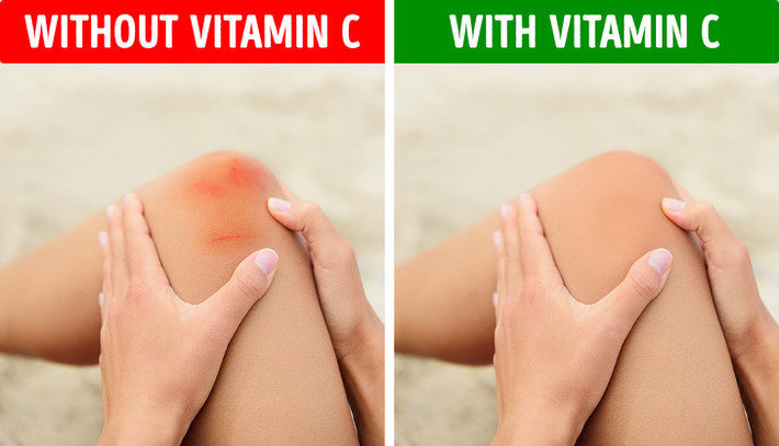 Dễ bị bầm tím: Nếu thường xuyên xuất hiện những vết bầm không rõ lý do, khả năng là bạn đang thiếu vitamin C. Cơ thể cần vitamin C để sản xuất collagen có tác dụng chữa lành vết thương. Hãy bổ sung trái cây và quả có múi vào chế độ ăn hàng ngày.
