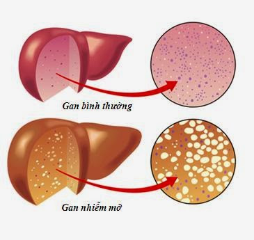 Gan nhiễm mỡ là tình trạng phổ biến do lười vận động, thừa năng lượng, cần tăng cường uống trà, nước ép, ăn rau xanh, hoa quả tươi, cháo đậu để thanh lọc gan.