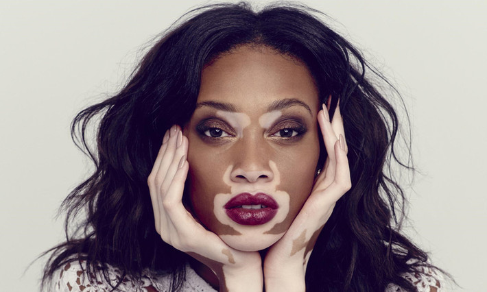 Winnie Harlow là cái tên quen thuộc của làng thời trang thế giới. Giữa vô số người mẫu sở hữu vẻ đẹp chuẩn mực, cô gái 24 tuổi trở thành hiện tượng lạ bởi làn da bạch biến, loang lổ khắp cơ thể. Điều này khiến cô bị người khác gọi là bò, ngựa vằn và nhiều lần có ý định tự sát. Sau khi vượt qua mặc cảm, cô quyết tâm chứng minh giá trị bản thân bằng cách tham gia America's Next Top Model 2014, để lại ấn tượng với khán giả bằng kỹ năng người mẫu chuyên nghiệp.