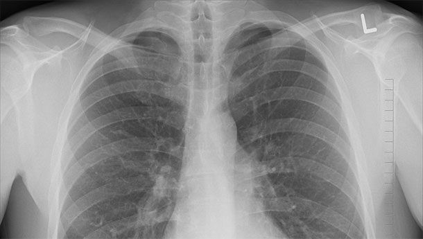 1. Bệnh lao là một bệnh truyền nhiễm gây ra bởi vi khuẩn Mycobacterium tuberculosis. Căn bệnh chủ yếu ảnh hưởng đến phổi nhưng các bộ phận khác của cơ thể cũng có thể bị tấn công. Ảnh: Webmd.