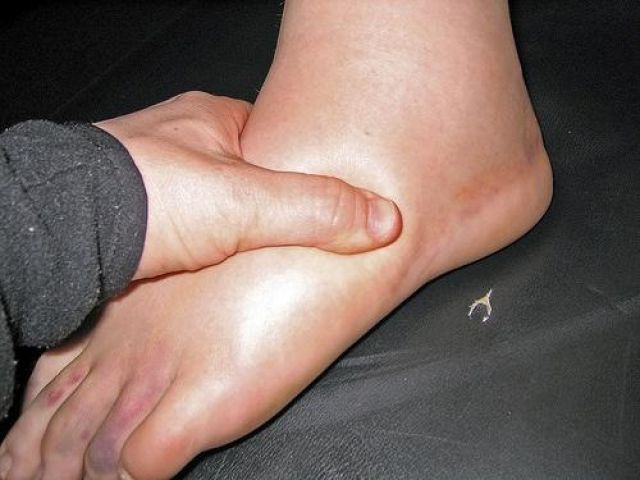 Phù nề: Tĩnh mạch chân bị giãn ra có thể làm tắc huyết khối tĩnh mạch, làm gián đoạn sự lưu chuyển của bạch huyết trong cách mạch bạch huyết. Từ đó, các hội chứng này khiến áp lực trong các mao mạch nhỏ gia tăng, chất lỏng từ huyết tương máu tiết ra sẽ đi vào các mô xung quanh. Chúng chứa nhiều muối và protein gây sưng, phù nề các cơ quan này. Ảnh: Anamariabianchini.