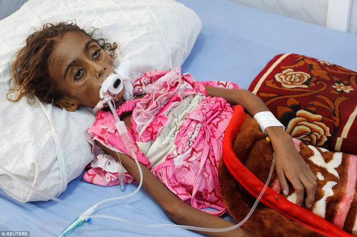 Không may mắn như Saida, cô bé bị suy dinh dưỡng Jamila Ali Abdu, 7 tuổi, cũng ở Yemen, đã tử vong tại một bệnh viện ở Hodeidah vào ngày 2/5. Ảnh: Reuters.