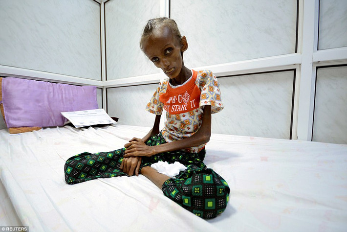 Cuộc chiến tranh kéo dài 2,5 năm qua tại Yemen đang khiến hàng ngàn người dân nơi đây rơi vào cảnh đói nghèo, trong đó có nhiều trẻ em bị suy dinh dưỡng nặng. Khoảng 1 năm trước, hình ảnh cô gái Saida Ahmed Baghili, 18 tuổi, chỉ nặng vỏn vẹn 11 kg, từng khiến dư luận thế giới cô cùng bàng hoàng. Hình ảnh này trở thành minh chứng rõ ràng nhất cho cuộc khủng hoảng nhân đạo tại Yemen. Ảnh: Reuters.