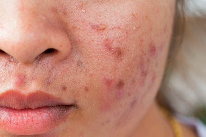 Lão hóa da: Trên thực tế, đường có thể gây ra mụn trứng cá và bệnh rosacea lây lan trên da. Đường kích hoạt sự viêm và liên kết với collagen có thể gây hại cho da lâu dài. Một phần lượng đường hấp thụ sau khi vào trong máu cũng trở thành protein. Những phân tử mới này làm mất đi tính đàn hồi của các mô đang bị lão hóa, từ da cho đến các bộ phận và động mạch. Do vậy, ăn càng nhiều đường thì quá trình lão hóa càng nhanh. Ảnh: Shutterstock.
