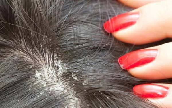 8. Gàu: Da đầu ẩm sẽ cản trở chức năng của tuyến tiết bã nhờn. Chúng có thể tiết thêm nhiều hoặc ít dầu hơn bình thường. Do đó, làm mất cân bằng độ pH trong da đầu. Kết quả, da đầu bị dầu, hoặc khô quá dẫn tới gàu. Ảnh: Internet.