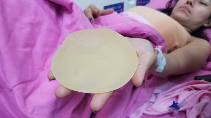 Quách Tuấn Du kể lại tình hình của Ivy Trần bị nổ túi ngực, đồng thời đưa ra cho cư dân mạng xem hình ảnhtúi ngực bị vỡ bởi chất lượng kém. Theo lời anh, nữ ca sĩ đã được các bác sĩ kịp thời xử lý bằng việc tháo bỏ túi ngực vỡ ra khỏi cơ thể, đồng thời vẫn có thể đặt túi ngực khác vào mà không bị nhiễm trùng.