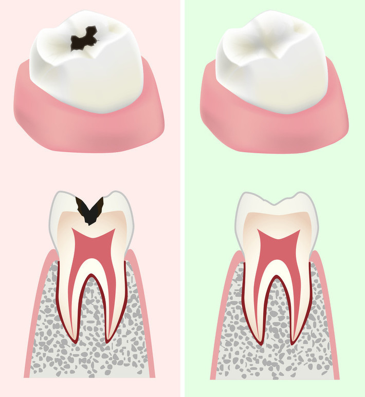 Cải thiện sức khỏe răng miệng: Dưa chuột có chứa molypden và fluoride, hai hợp chất giúp chữa răng sâu hiệu quả. Hàm lượng canxi trong dưa chuột giúp răng chắc khỏe hơn.
