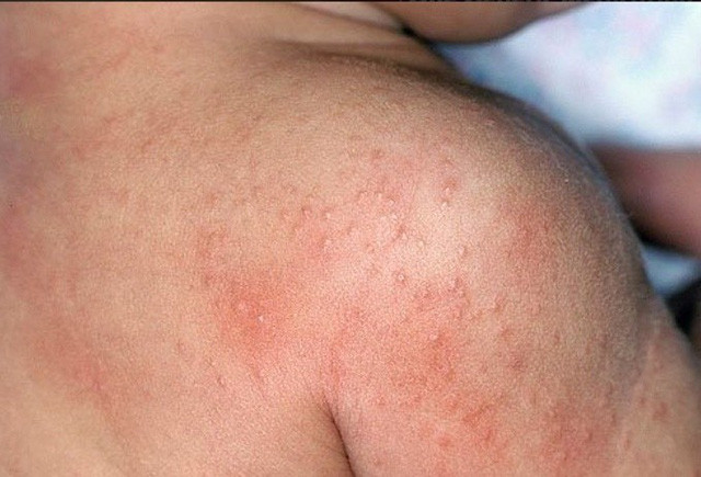 Chữa rôm sảy: Rôm sẩy không chỉ gây ngứa ngáy khó chịu mà còn có thể gây biến chứng viêm cầu thận, nhiễm trùng lan rộng rất nguy hiểm. Hàng ngày ăn rau má tươi, hoặc giã nát vắt lấy nước uống, nếu trẻ nhỏ, có thể thêm chút đường hoặc mật ong cho dễ uống.