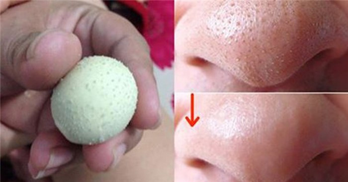 Đơn giản hơn, bạn có thể luộc trứng gà, bóc vỏ, sau đó bọc trong một miếng vải và lăn khắp vùng mũi bị mụn đầu đen cho đến khi trứng nguội hẳn. Do hơi nóng của trứng, nhân mụn đầu đen sẽ được hút hết ra ngoài.