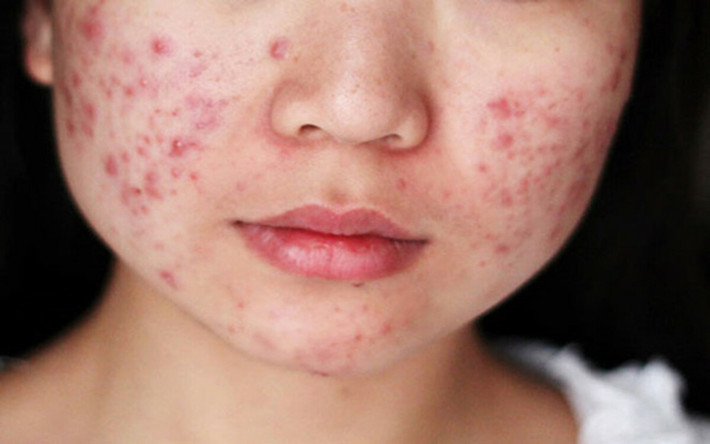 Gây ra các vấn đề về da, răng, xương: Các nghiên cứu đã chỉ ra mối liên quan giữa việc tiêu thụ thức ăn nhanh với mụn trứng cá và bệnh eczema. Đồng thời, tiêu thụ thức ăn nhanh cũng gây ra các vấn đề về răng do đường tinh chế và carbohydrate tạo môi trường rất tốt cho vi khuẩn phát triển trong miệng.