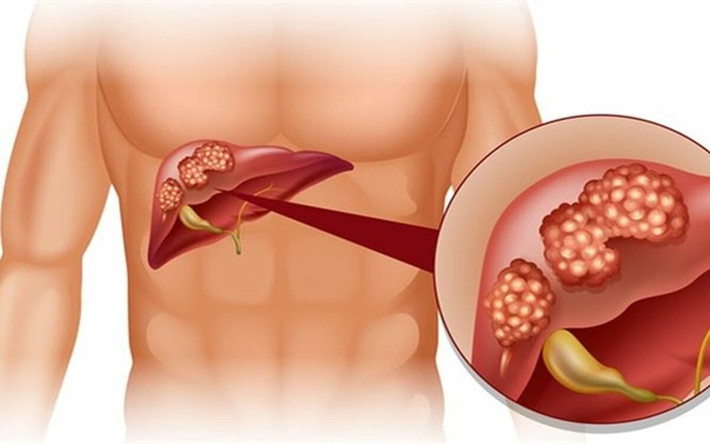 Tổn thương gan: Một số nghiên cứu đã chỉ ra rằng thức ăn nhanh có hại cho gan gần như rượu, ăn thức ăn nhanh trong 4 tuần có thể ảnh hưởng xấu đến men gan. Ngoài ra, chất béo chuyển hóa từ đồ ăn vặt có thể lắng đọng trong gan, gây ra các vấn đề về gan.