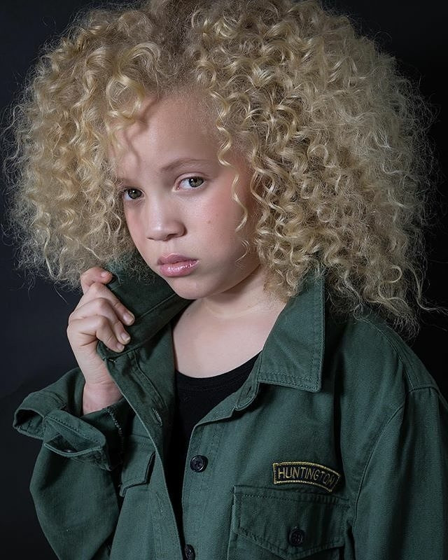 Albinism là hội chứng di truyền nổi tiếng làm người mắc bệnh bị điếc, giảm thị lực và nhiều biến chứng nguy hiểm khác. Tuy nhiên, những người mắc albinism thường có vẻ ngoài rất thu hút. Ảnh: BS.