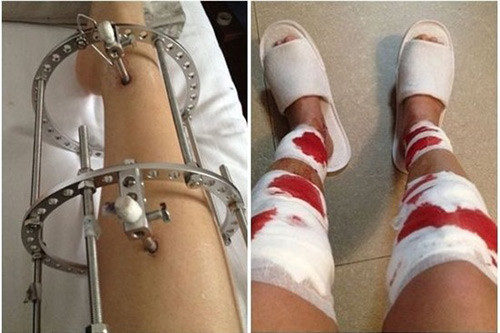 Sau nhiều tháng, đôi chân của cô gái sẽ dài ra. Tuy nhiên, mức độ đau đớn cũng như những biến chứng sau phẫu thuật sẽ đeo đuổi cô gái này suốt cả cuộc đời.