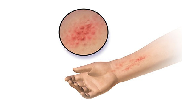 Dị ứng thường được coi là bệnh nhẹ và không được chú ý nhiều. Tuy nhiên đối với một số người, dị ứng thực sự có thể giết chết họ. Có những người thậm chí bị dị ứng với nước. (Nguồn List 25)