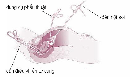 Tiếp đó, bác sĩ sẽ rạch thêm một đường nhỏ khác dài khoảng 1,5 cm để đưa các dụng cụ khác cần thiết cho ca phẫu thuật vào ổ bụng. Họ cũng đưa thêm một cần điều khiền vào tử cung qua ngả âm đạo - cổ tử cung, giúp bác sĩ quan sát dễ dàng hơn khi mổ.