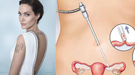 Bác sĩ sẽ khoanh vùng và rạch một đường nhỏ ở dưới rốn để đưa ống thông vào ổ bụng. Họ bơm khí CO2 vào ổ bụng giúp các thao tác dể dàng hơn, và quan sát khu vực buồng trứng, ống dẫn trứng rõ ràng hơn. Kỹ thuật viên khác sẽ điều chỉnh đèn nội soi, làm hiển thị hình ảnh các bộ phận cần phẫu thuật lên màn hình.
