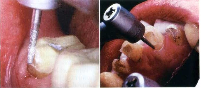 Quá trình mài răng thẩm mỹ nếu được thực hiện bởi bác sĩ không có chuyên môn có thể chạm đến tủy răng, buột phải lấy tủy, khi đó răng bạn sẽ không còn được khỏe mạnh như trước.