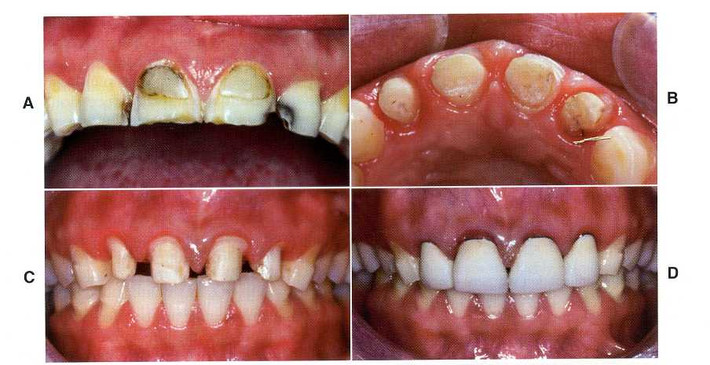 Tuy nhiên, đây không phải là phương pháp làm đẹp răng lý tưởng và bền vững. Sau khi mài răng bạn sẽ phải chịu những cơn đau đớn khá khủng khiếp. Bạn có thể thường xuyên cảm thấy ê buốt răng trong một thời gian dài.