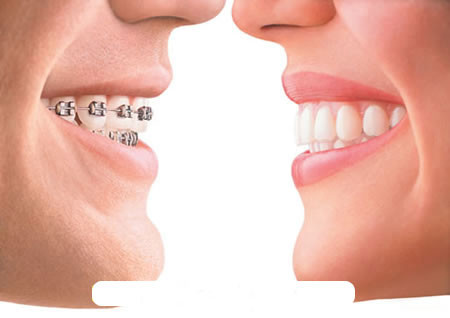 Mặc dù có nhiều lợi ích nhưng niềng răng cũng gây ra một số tác hại không mong muốn. Trong một số trường hợp không cần thiết, việc niềng răng có thể làm cho răng yếu đi. Thậm chí, nếu các bác sĩ thao tác không cẩn thận, có thể còn gây hại cho răng.