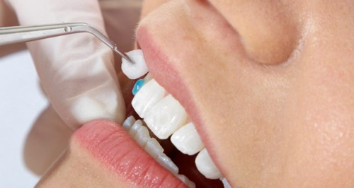 Ngoài ra bạn còn có thể phải chịu những di chứng cực nặng nề khi mài răng để bọc răng sứ. Sau khi mài răng bọc răng sứ, bạn sẽ phải chịu những cơn đau đớn khá khủng khiếp.