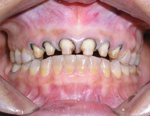 Mài răng để làm trắng răng cũng là phương pháp được khá nhiều người lựa chọn. Mài răng thẩm mỹ là phương pháp dùng dụng cụ chuyên dụng mài đi một lớp men mỏng phía ngoài răng. Bạn có thể mài tạo hình lại khuôn răng của mình hoặc mài để làm trắng răng.