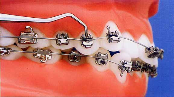 Trong quá trình niềng răng nếu dùng lực quá mạnh có thể làm tụt lợi, tiêu xương ổ răng, chân răng dẫn tới giảm tuổi thọ răng hoặc sai khớp răng cắn ảnh hưởng đến hệ thống nhai, khớp thái dương và hàm sau này. Niềng răng không đúng cách còn làm mất răng do răng lung lay phải nhổ.