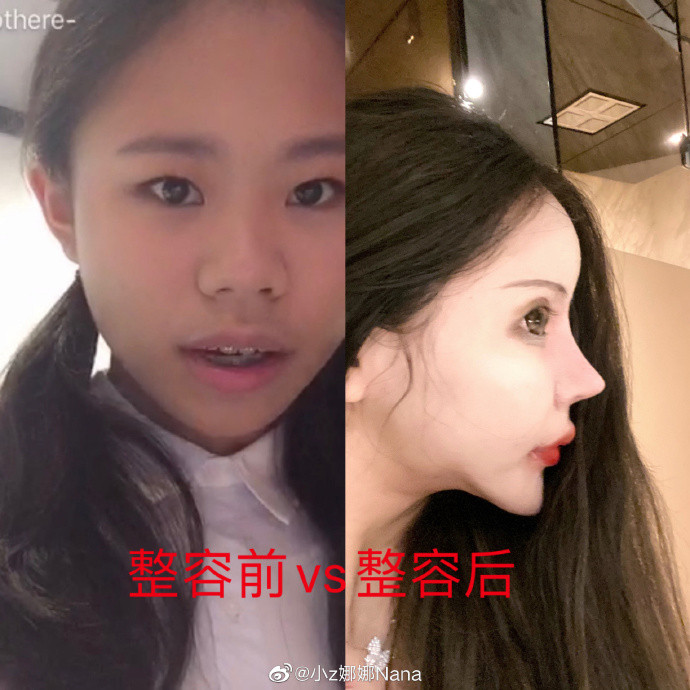 Ngoài việc đăng tải hình ảnh so sánh bản thân trước và sau khi "đập mặt xây lại", Nana còn đính kèm thêm những tờ hóa đơn, thông tin chuyển khoản để chứng minh việc phẫu thuật.