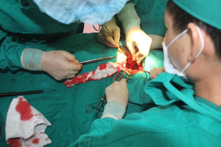 Thông thường chu vi sỏi thận là 9 cm. Theo đó, Ghuge nắm giữ kỷ lục có viên sỏi thận to nhất thế giới.