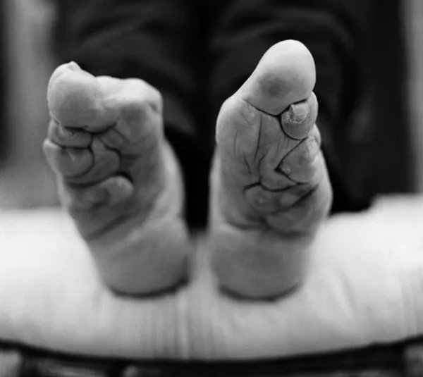 Thời phong kiến, phụ nữ Trung Quốc phải bó chân để có "gót sen ba tấc". Việc bó chân ảnh hưởng lớn đến cuộc sống sinh hoạt thường ngày của họ.