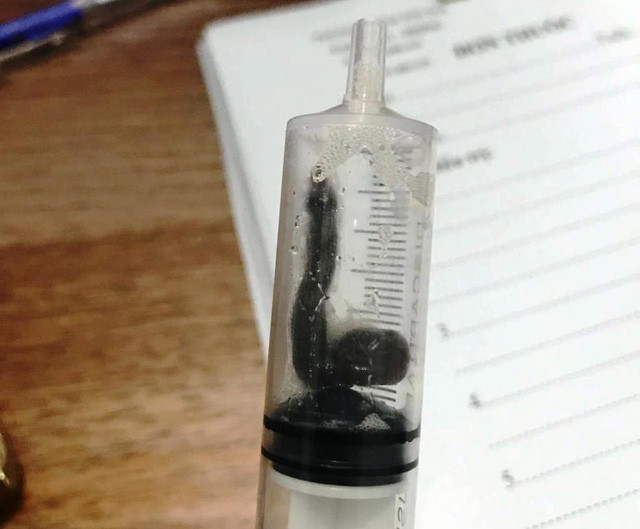 Theo bác sĩ, cháu Tiến kể lại trước đó tầm 1 tháng em có đi tắm ở suối và bị con vắt chui vào mũi mà không biết. Còn bà Bính cũng bị con vắt chui vào mũi nhưng không hề hay biết khi uống nước khe suối.