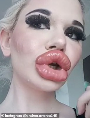 Andrea Emilova Ivanova nói: "Tôi thấy rất tuyệt khi được tiêm dày hơn nhưng một số bác sĩ lại nghĩ rằng thế là đủ rồi. Bác sĩ của tôi bảo sẽ tiêm thêm cho tôi nhưng phải đợi ít nhất hai tháng nữa".