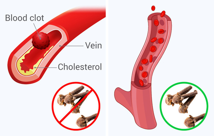 Làm chậm quá trình đông máu: Các eugenol được tìm thấy trong đinh hương được biết là làm chậm quá trình đông máu. Chỉ cần lưu ý rằng điều này có thể phản ứng xấu với thuốc làm loãng máu. Nên hỏi bác sĩ trước khi bạn thêm đinh hương vào chế độ ăn uống. Ảnh: BS.