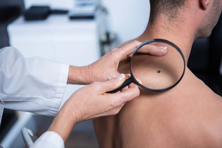 Thay đổi màu da: Khi thấy sự thay đổi trong kích thước, hình dạng, hoặc màu sắc của nốt ruồi hoặc các vết khác trên da, hãy gặp bác sĩ càng sớm càng tốt. Những vết mới xuất hiện hoặc bị biến đổi rất có thể là dấu hiệu ban đầu của bệnh ung thư da.