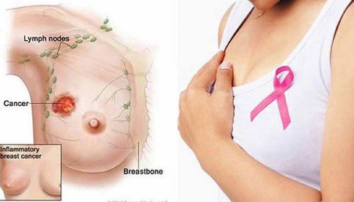 Tăng sản tuyến vú, ung thư vú: Nữ giới dễ nổi cáu có thể bị sưng, đau tức ngực, tăng sản tuyến vú. Tâm trạng tức giận không có lợi cho gan, trì trệ khí huyết, ứ đọng máu, tăng sản tuyến vú và có nguy cơ ung thư vú.