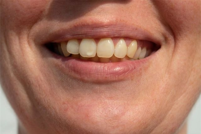 Các vết trên răng: Nếu bạn nhận thấy những đốm trắng, vàng hoặc nâu trên răng không phải do cà phê, trà hoặc hút thuốc, thì chúng có thể là dấu hiệu của bệnh celiac. Rối loạn tự miễn này là một phản ứng khi ăn gluten. Một loại protein có trong lúa mì, lúa mạch đen và lúa mạch, dẫn đến tổn thương dạ dày và khó hấp thụ chất dinh dưỡng.