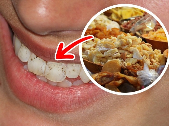 Trái cây sấy khô: Táo và lê khô rất ngọt trong khi mơ, mận và các loại trái cây khô khác lại rất nguy hiểm do độ dính cao. Đường trong trái cây khô cũng gây sâu răng và làm hỏng men răng.
