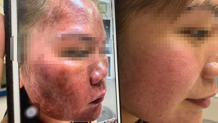 Mới đây, bệnh nhân nữ, 26 tuổi, ở Thanh Chương, Nghệ An đến khám tại Bệnh viện Da liễu Trung ương trong tình trạng da mặt bị bỏng, phù nề, đỏ thẫm, ngứa rát. Nguyên nhân là do cô đã chọn dùng mỹ phẩm trôi nổi không rõ nguồn gốc. Ảnh: Nhân Dân.