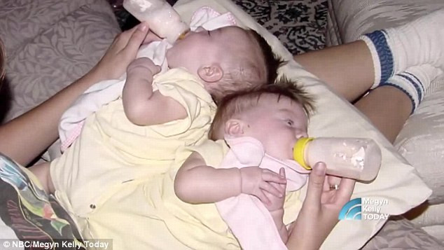 Ngày 9/3/2001, cặp song sinh Lexi và Sydney Stark chào đời với phần sau mông dính liền với nhau. Bố mẹ bé vừa chăm sóc con dưới sự giúp đỡ theo dõi của các bác sĩ vừa nghĩ đến chuyện làm phẫu thuật tách rời cơ thể cho các con. Phải mất 7 tháng họ mới có thể đưa ra quyết định.