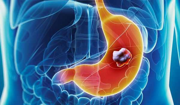 Loét dạ dày: Bực tức thường xuyên gây phấn khích thần kinh giao cảm. Nó tác động trực tiếp lên mạch máu và tim, làm chậm lưu lượng máu đến nhu động ruột, tăng nguy cơ bị loét dạ dày.
