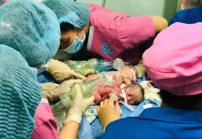 Cặp song sinh dính liền Trúc Nhi và Diệu Nhi, ở quận 9, TP HCM, chào đời ngày 7/6/2019, lúc 33 tuần thai, tại Bệnh viện Hùng Vương, cân nặng 3,2 kg.