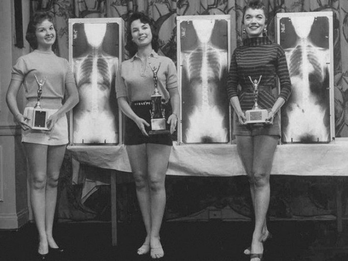 Vào những năm 1950, cuộc thi chọn người có cột sống đẹp nhất được tổ chức trong khuôn khổ một hội nghị về chỉnh hình ở Chicago, Mỹ. Trong ảnh là 3 phụ nữ giành giải thưởng cao nhất của cuộc thi. Phía sau là ảnh chụp X quang của họ cho thấy những người này có tư thế đứng đẹp nhất.